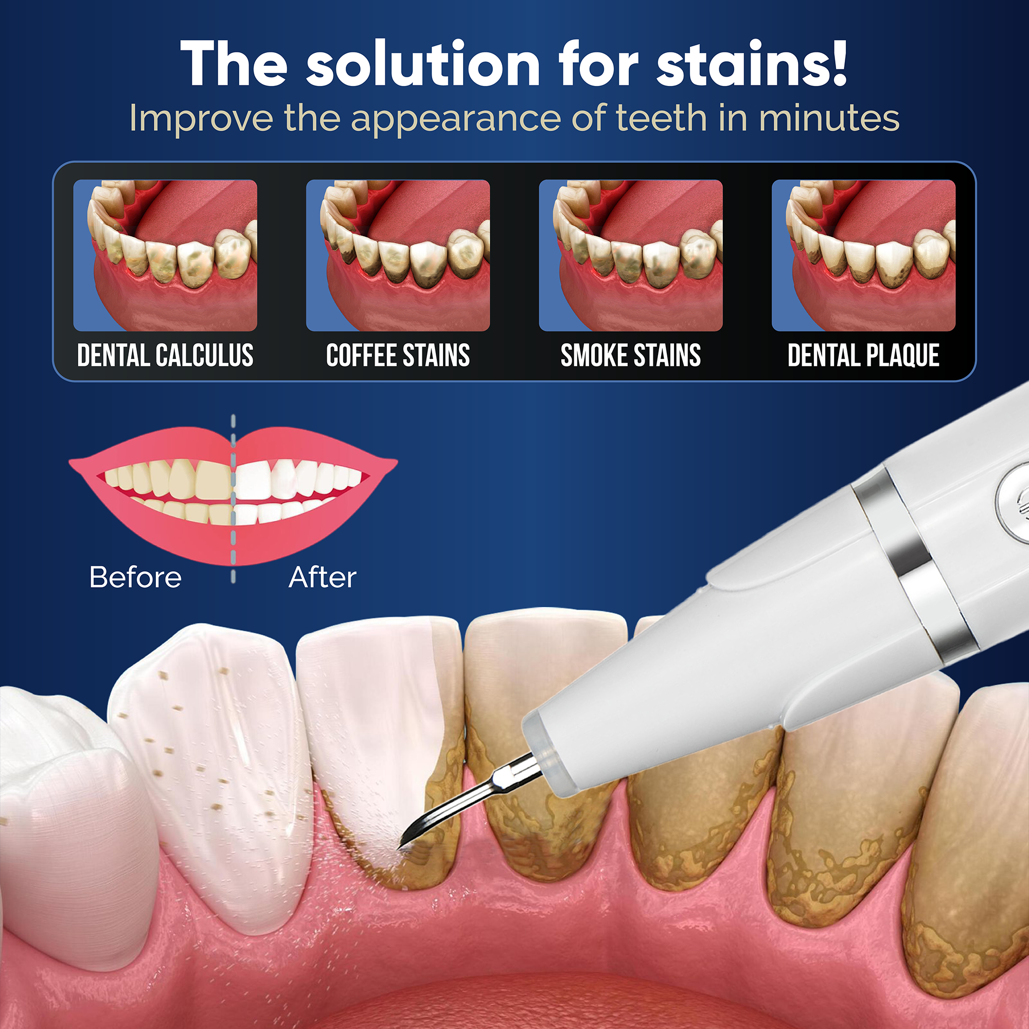Ultrasonic tooth cleaner One bright plaque remover